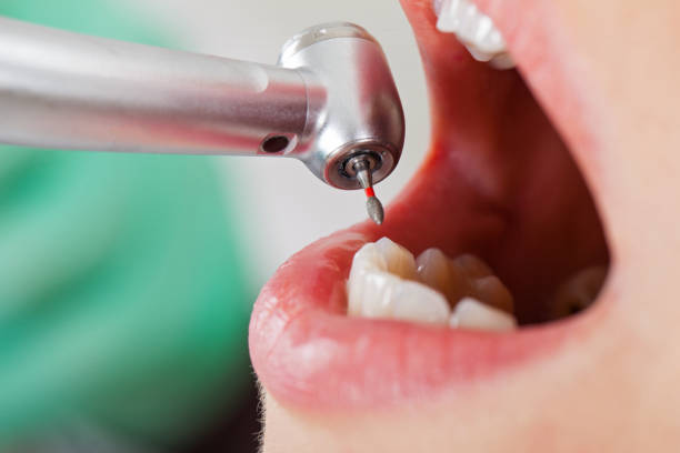 Best Emergency Treatment for Oral Infections in Micco, FL